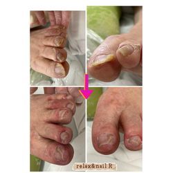 肥厚爪2の画像1