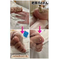 肥厚爪3の画像1