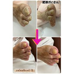 肥厚爪4の画像1