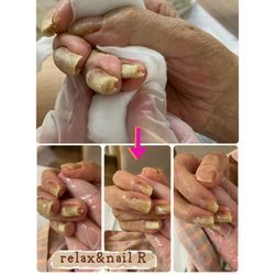 肥厚爪1の画像1