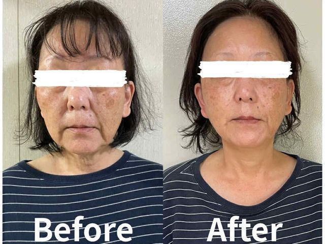 輪郭くっきり！若見えリフトアップ小顔整顔/小顔矯正